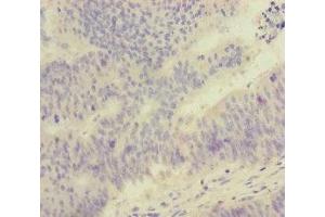 Immunohistochemistry of paraffin-embedded human colon cancer using ABIN7152525 at dilution of 1:100