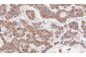 ABIN6273985 at 1/100 staining Human liver cancer tissue by IHC-P. (OR2V2 antibody  (Internal Region))