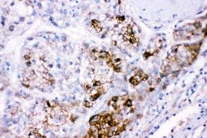 IHC-P: CBS antibody testing of human liver cancer tissue (CBS antibody  (AA 331-551))