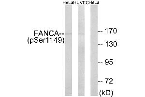 Immunohistochemistry analysis of paraffin-embedded human colon carcinoma tissue using FANCA (Phospho-Ser1149) antibody.