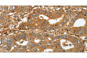 Immunohistochemistry of paraffin-embedded Human gastric cancer tissue using RAP1A Polyclonal Antibody at dilution 1:45 (RAP1A antibody)