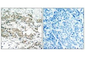 Immunohistochemical analysis of paraffin-embedded human breast carcinoma tissue using AFX(Phospho-Ser197) Antibody(left) or the same antibody preincubated with blocking peptide(right). (FOXO4 antibody  (pSer197))