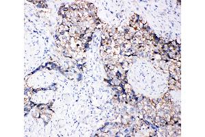 Anti-Eph receptor B3 antibody, IHC(P) IHC(P): Human Lung Cancer Tissue (EPH Receptor B3 antibody  (C-Term))