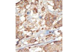 Formalin-fixed and paraffin-embedded human cancer tissue reacted with the primary antibody, which was peroxidase-conjugated to the secondary antibody, followed by AEC staining. (EPH Receptor A6 antibody  (C-Term))