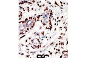 Formalin-fixed and paraffin-embedded human cancer tissue reacted with the primary antibody, which was peroxidase-conjugated to the secondary antibody, followed by AEC staining. (MLL/KMT2A antibody  (C-Term))