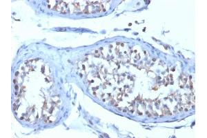 Formalin-fixed, paraffin-embedded human Testicular Carcinoma stained with B7-H4 Mouse Monoclonal Antibody (B7H4/1788).