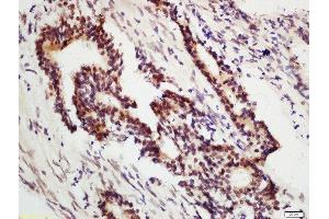 Formalin-fixed and paraffin embedded human colon carcinoma labeled with Anti-DNA Polymerase gamma Polyclonal Antibody, Unconjugated  at 1:200 followed by conjugation to the secondary antibody and DAB staining.