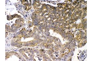 IHC testing of FFPE human intestinal cancer tissue with GAD65 antibody at 1ug/ml. (GAD65 antibody  (AA 131-164))