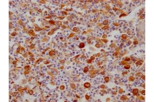 IHC image of ABIN7127486 diluted at 1:100 and staining in paraffin-embedded human lung cancer performed on a Leica BondTM system. (Recombinant FDFT1 antibody)