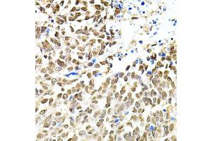 Immunohistochemistry of paraffin-embedded human lung cancer using PNKP antibody.