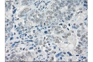 Immunohistochemical staining of paraffin-embedded colon tissue using anti-SLC7A8mouse monoclonal antibody. (SLC7A8 antibody)