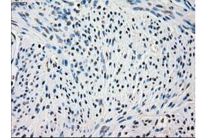 Immunohistochemical staining of paraffin-embedded Adenocarcinoma of colon tissue using anti-FRKmouse monoclonal antibody. (FRK antibody)