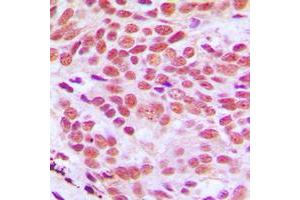 Immunohistochemical analysis of Histone H2B staining in human breast cancer formalin fixed paraffin embedded tissue section. (Histone H2B antibody  (N-Term))