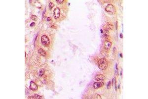 Immunohistochemical analysis of Sm-D2 staining in human lung cancer formalin fixed paraffin embedded tissue section. (SNRPD2 antibody)