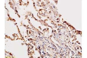 Formalin-fixed and paraffin embedded human lung labeled with Anti-Beta-HCG/HCG beta Polyclonal Antibody, Unconjugated  at 1:200, followed by conjugation to the secondary antibody and DAB staining (HCG beta antibody  (AA 81-165))