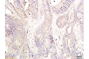 Formalin-fixed and paraffin embedded: human colon cancer tissue labeled with Anti-Dnmt-3-beta Polyclonal Antibody, Unconjugated (ABIN727623) at 1:600, followed by conjugation to the secondary antibody and DAB staining (DNMT3B antibody  (AA 1-80))