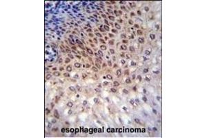 CCDC36 Antibody (C-term) (ABIN655696 and ABIN2845150) immunohistochemistry analysis in formalin fixed and paraffin embedded human esophageal carcinoma followed by peroxidase conjugation of the secondary antibody and DAB staining. (CCDC36 antibody  (C-Term))