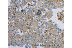 Immunohistochemistry of Human lung cancer using CKMT1A/CKMT1B Polyclonal Antibody at dilution of 1:100 (CKMT1A antibody)