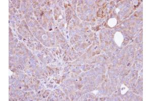 IHC-P Image Immunohistochemical analysis of paraffin-embedded SW480 xenograft , using Steroid sulfatase , antibody at 1:100 dilution. (STS antibody)