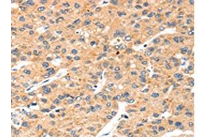 The image on the left is immunohistochemistry of paraffin-embedded Human liver cancer tissue using ABIN7192531(SLC8B1 Antibody) at dilution 1/20, on the right is treated with synthetic peptide. (SLC24A6 antibody)