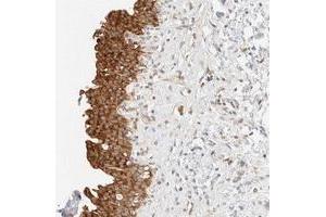 Immunohistochemical staining of human urinary bladder with TBC1D8B polyclonal antibody  shows strong cytoplasmic positivity in urothelial cells.