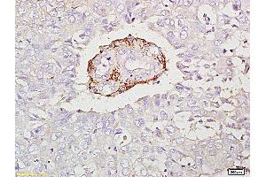 Formalin-fixed and paraffin embedded human laryngeal carcinoma labeled with Anti-IL-17C Polyclonal Antibody, Unconjugated (ABIN747983) at 1:200 followed by conjugation to the secondary antibody and DAB staining (IL17C antibody  (AA 101-197))