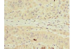 Immunohistochemistry of paraffin-embedded human liver cancer using ABIN7173011 at dilution of 1:100 (TMPRSS6 antibody  (AA 98-301))