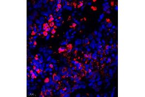 Immunofluorescence of paraffin embedded human lung cancer using AHSG (ABIN7073021) at dilution of 1:650 (400x lens) (Fetuin A antibody)