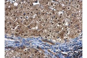 IHC-P Image PSMC5 antibody detects PSMC5 protein at cytoplasm and nucleus in human hepatocellular carcinoma by immunohistochemical analysis.