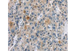 Immunohistochemical analysis of paraffin-embedded Human liver cancer tissue using at dilution 1/30. (CACNA2D1 antibody  (Internal Region))