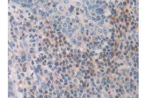 Detection of FDFT1 in Human Skin cancer Tissue using Polyclonal Antibody to Farnesyl Diphosphate Farnesyltransferase 1 (FDFT1) (FDFT1 antibody  (AA 269-417))