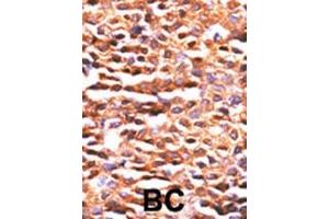 Formalin-fixed and paraffin-embedded human cancer tissue reacted with the primary antibody, which was peroxidase-conjugated to the secondary antibody, followed by DAB staining. (PPP2CA antibody  (N-Term))