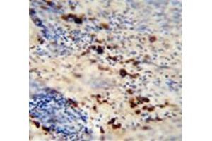 Immunohistochemistry analysis in human skin carcinoma (Formalin-fixed, Paraffin-embedded) using LCE1A  Antibody (C-term), followed by peroxidase conjugation of the secondary antibody and DAB staining. (LCE1A antibody  (C-Term))
