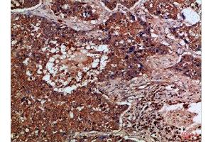 Immunohistochemical analysis of paraffin-embedded Human-lung-cancer, antibody was diluted at 1:100 (FLT4 antibody  (AA 720-760))