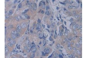 Detection of YARS in Human Breast cancer Tissue using Polyclonal Antibody to Tyrosyl tRNA Synthetase (YARS) (YARS antibody  (AA 2-528))