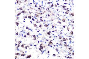 Immunohistochemistry of paraffin-embedded human liver cancer using NCL Rabbit pAb (ABIN6128392, ABIN6144411, ABIN6144412 and ABIN6221613) at dilution of 1:100 (40x lens). (Nucleolin antibody  (AA 461-710))