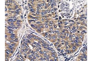 ABIN6258527 and ABIN6274787 at 1/100 staining human lung cancer and adjacent non-tumor tissue by IHC-P. (ABHD11 antibody  (C-Term))