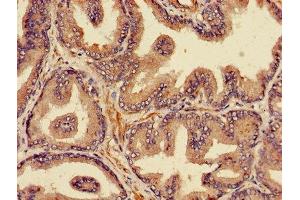 Immunohistochemistry of paraffin-embedded human prostate cancer using ABIN7164978 at dilution of 1:100 (PSMB4 antibody  (AA 46-264))