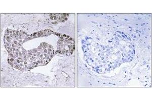 Immunohistochemistry analysis of paraffin-embedded human breast carcinoma tissue, using GATA1 (Ab-142) Antibody. (GATA1 antibody  (AA 109-158))