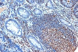 Immunohistochemistry of paraffin-embedded human colon carcinoma using FEN-1 Rabbit mAb (ABIN7267215) at dilution of 1:100 (40x lens). (FEN1 antibody)