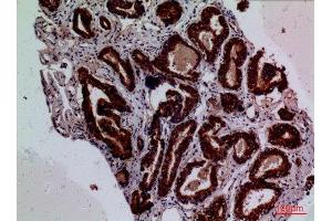 Immunohistochemistry (IHC) analysis of paraffin-embedded Human Prostate Cancer, antibody was diluted at 1:100. (Tissue factor antibody  (Internal Region))