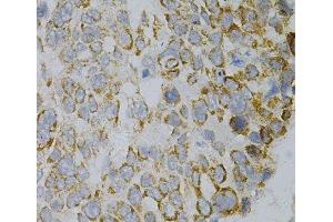 Immunohistochemistry of paraffin-embedded Human esophageal cancer using GNAO1 Polyclonal Antibody at dilution of 1:100 (40x lens). (GNAO1 antibody)