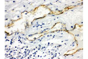 Anti- Aquaporin 1 Picoband antibody, IHC(P) IHC(P): Human Intestinal Cancer Tissue (Aquaporin 1 antibody  (C-Term))