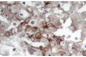 Immunohistochemistry analysis of Cortactin Antibody in paraffin-embedded human breast carcinoma tissue. (Cortactin antibody)