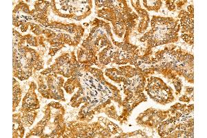 ABIN6265828 and ABIN6269033 at 1/100 staining Human kidney cancer by IHC-P. (TYR antibody  (C-Term))