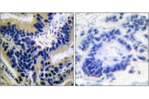 Immunohistochemistry analysis of paraffin-embedded human lung carcinoma, using Caspase 3 (Cleaved-Asp175) Antibody. (Caspase 3 antibody  (Cleaved-Asp175))