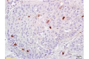 Formalin-fixed and paraffin embedded human lung carcinoma labeled with Anti-ADAMTS1 Polyclonal Antibody, Unconjugated (ABIN673404) at 1:200 followed by conjugation to the secondary antibody and DAB staining.
