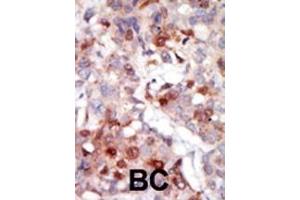 Formalin-fixed and paraffin-embedded human cancer tissue reacted with the primary antibody, which was peroxidase-conjugated to the secondary antibody, followed by AEC staining. (AKT3 antibody  (AA 88-118))