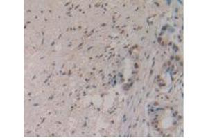 IHC-P analysis of Human Pancreas Cancer Tissue, with DAB staining. (MSTN antibody  (AA 266-375))