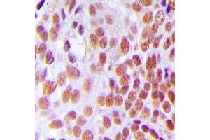 Immunohistochemical analysis of GTF3C2 staining in human breast cancer formalin fixed paraffin embedded tissue section.